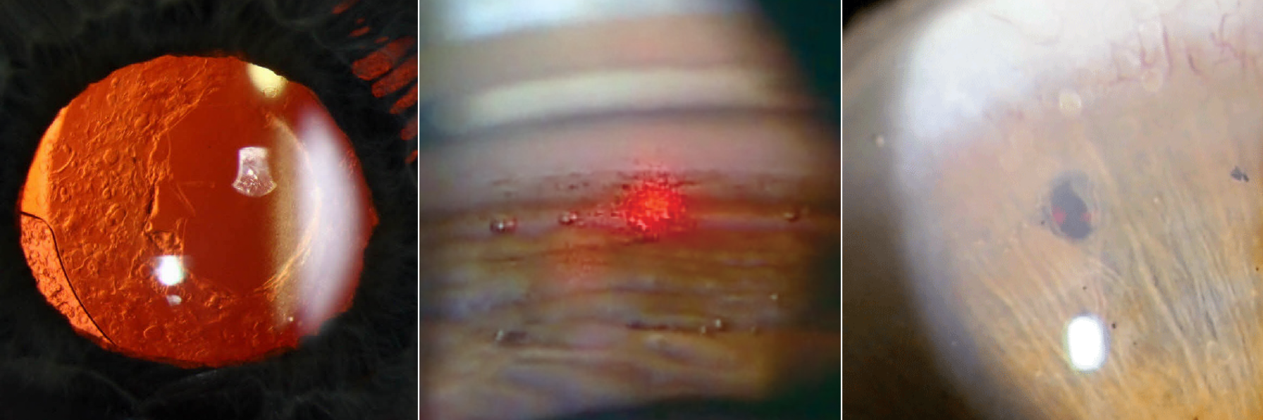 Most states with scope expansion legislation in play in 2024 are pushing optometric laser privileges, which will help improve patient access to these necessary procedures for glaucoma and post-cataract surgery care.
