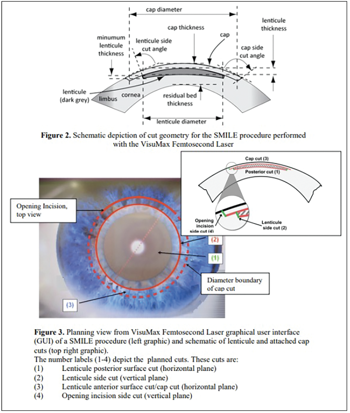 Figs. 2 and 3. These images illustrate the key components of the SMILE procedure; the top diagram shows the schematic cross-section of cut geometry, detailing the lenticule dimensions and corneal parameters. The lower image displays the VisuMax Femtosecond Laser graphical user interface during surgery, showing the planned circular incision pattern and the four sequential laser cuts required to create and extract the lenticule.